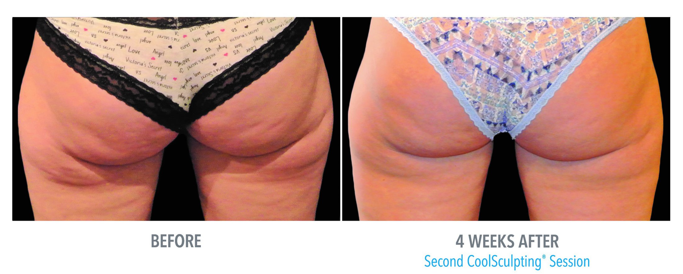 Coolsculpting Before and After Feature 2