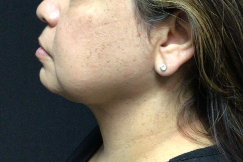 Liposuction Before & After Image