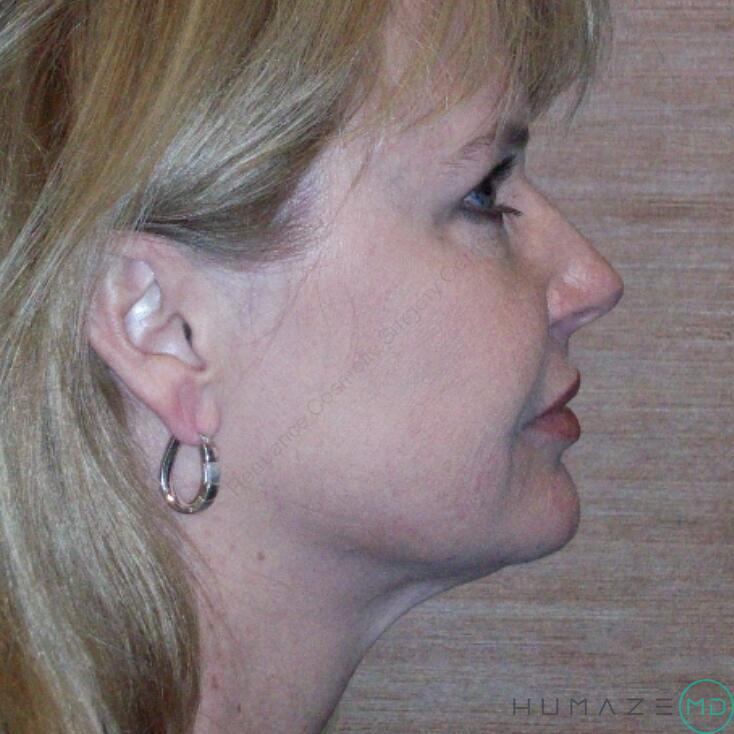 Liposuction Before & After Image