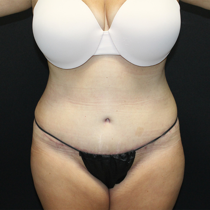 Tummy Tuck Before & After Image