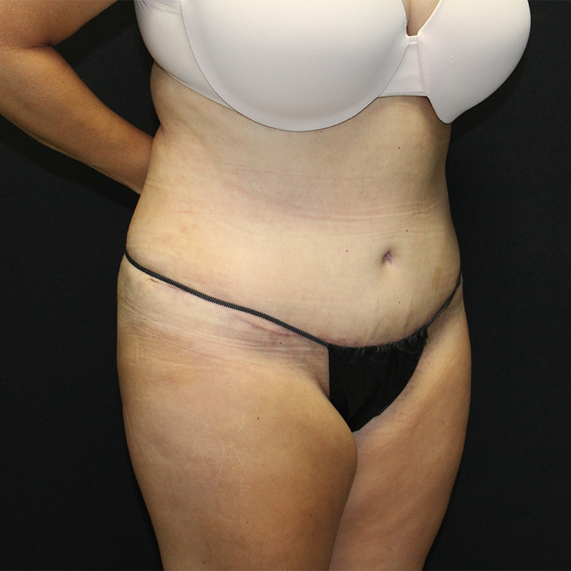 Tummy Tuck Before & After Image