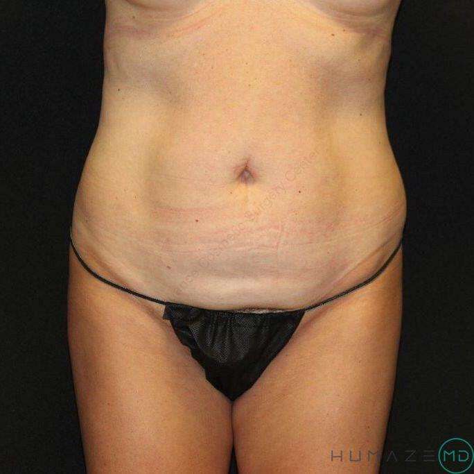 Tummy Tuck Before & After Image