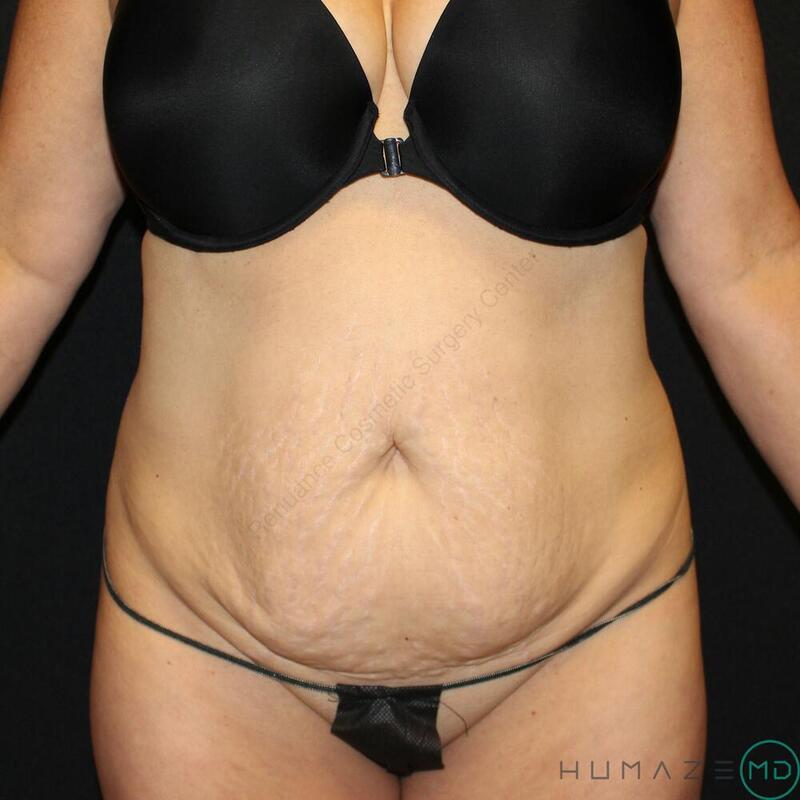 Tummy Tuck Before & After Image