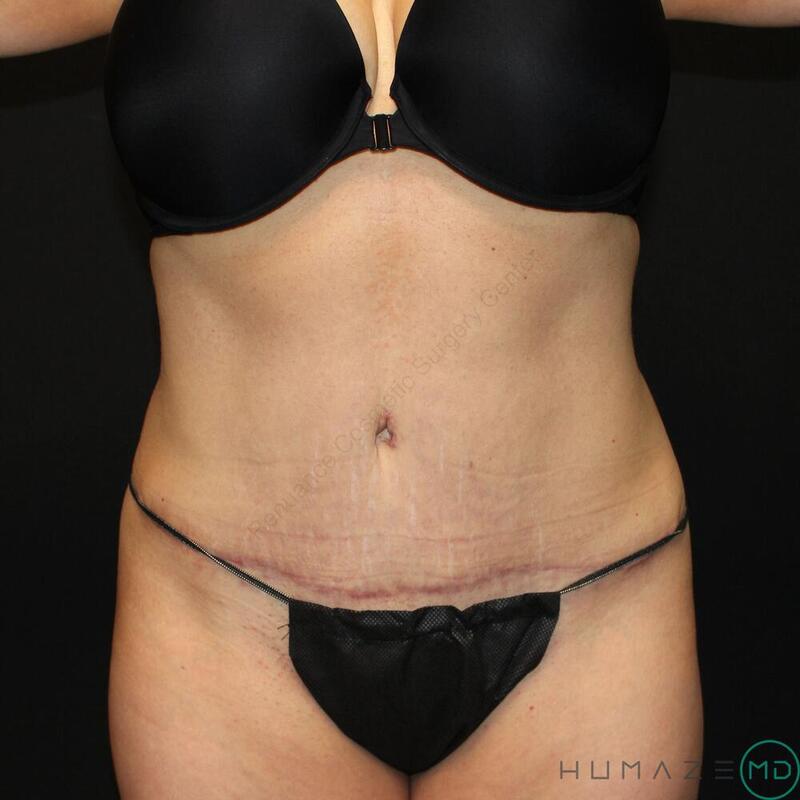 Tummy Tuck Before & After Image