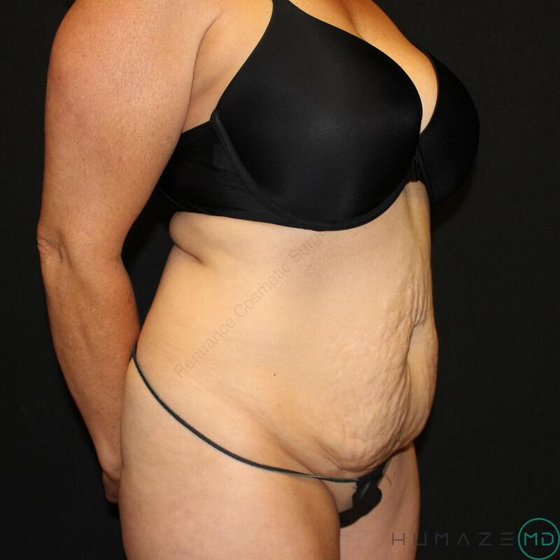 Tummy Tuck Before & After Image
