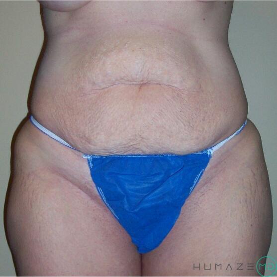Tummy Tuck Before & After Image