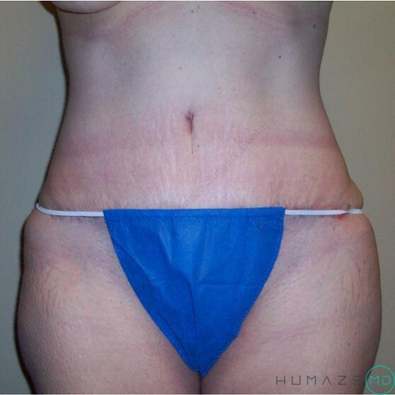 Tummy Tuck Before & After Image