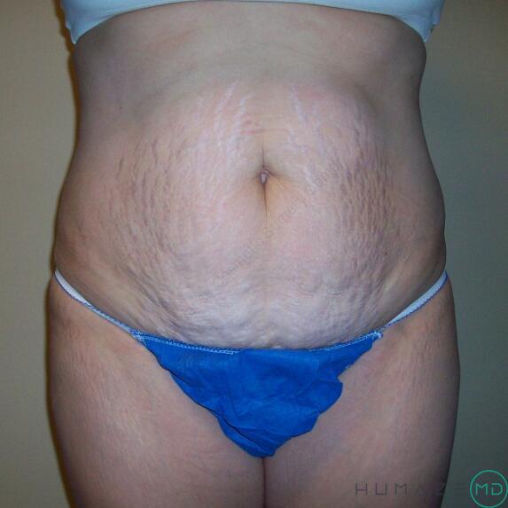 Tummy Tuck Before & After Image