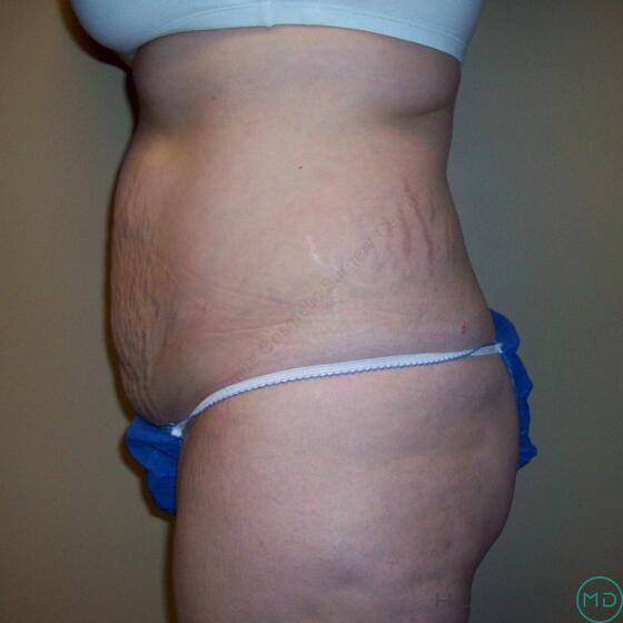 Tummy Tuck Before & After Image
