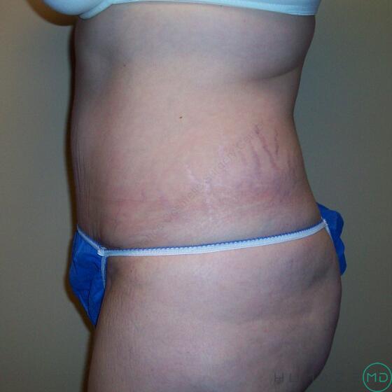 Tummy Tuck Before & After Image
