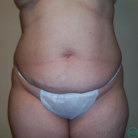 Tummy Tuck Before & After Image