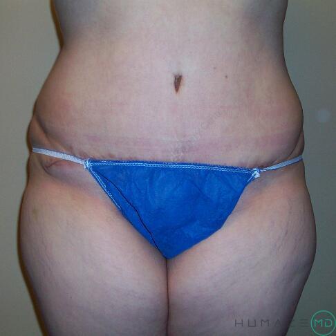 Tummy Tuck Before & After Image