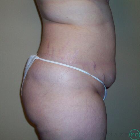 Tummy Tuck Before & After Image
