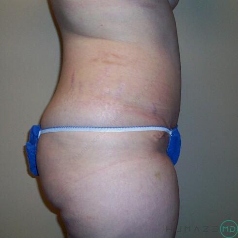 Tummy Tuck Before & After Image
