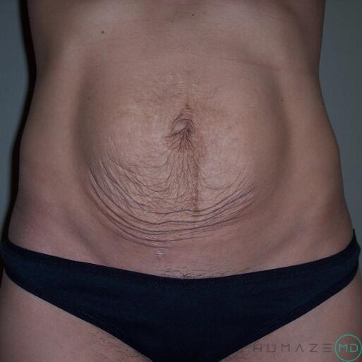 Tummy Tuck Before & After Image