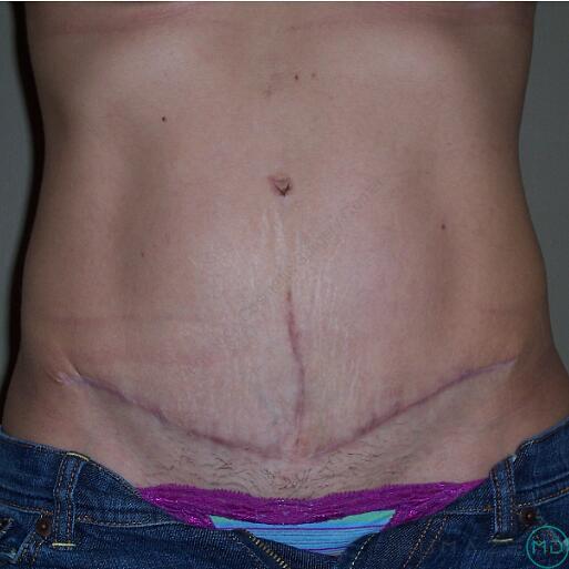 Tummy Tuck Before & After Image