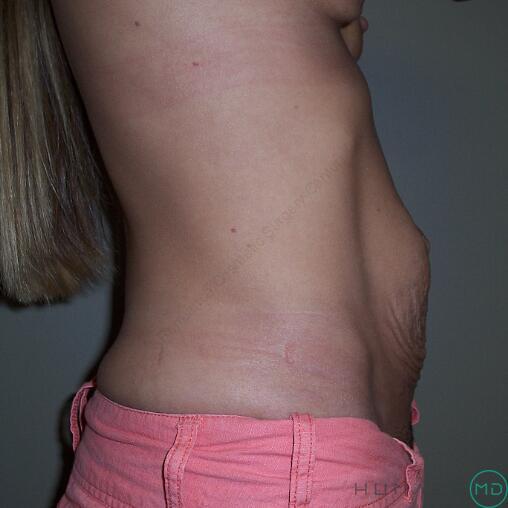 Tummy Tuck Before & After Image