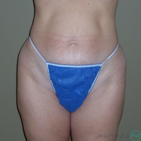 Tummy Tuck Before & After Image