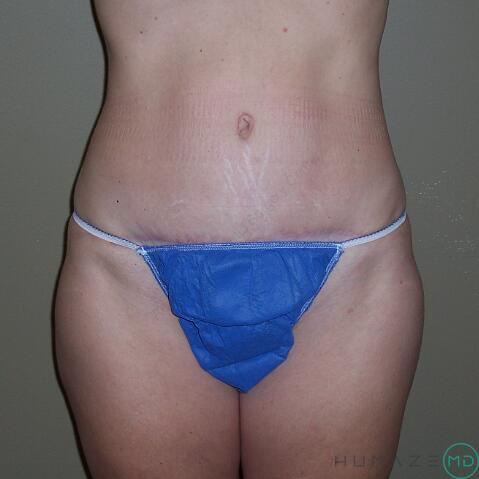 Tummy Tuck Before & After Image