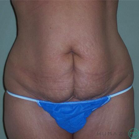 Tummy Tuck Before & After Image