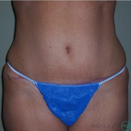 Tummy Tuck Before & After Image