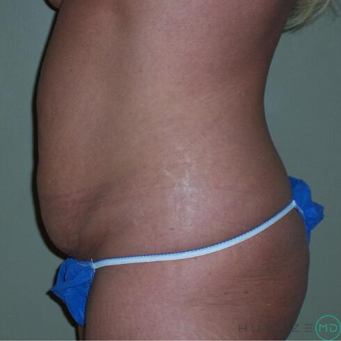 Tummy Tuck Before & After Image