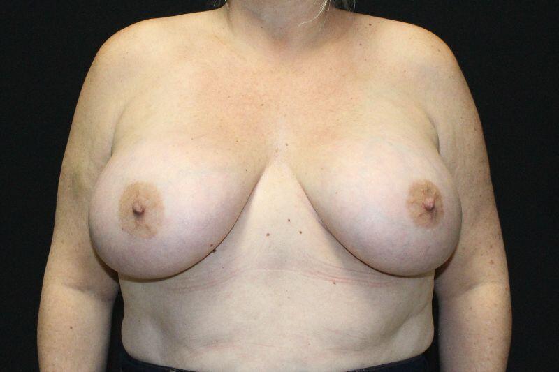 Breast Augmentation Before & After Image
