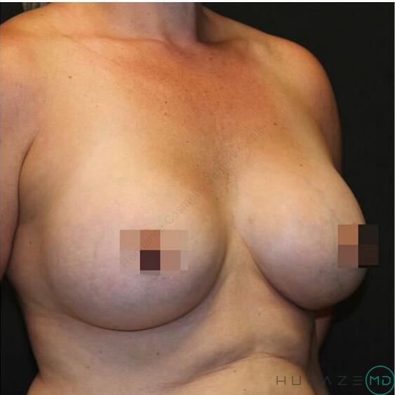 Breast Augmentation Before & After Image