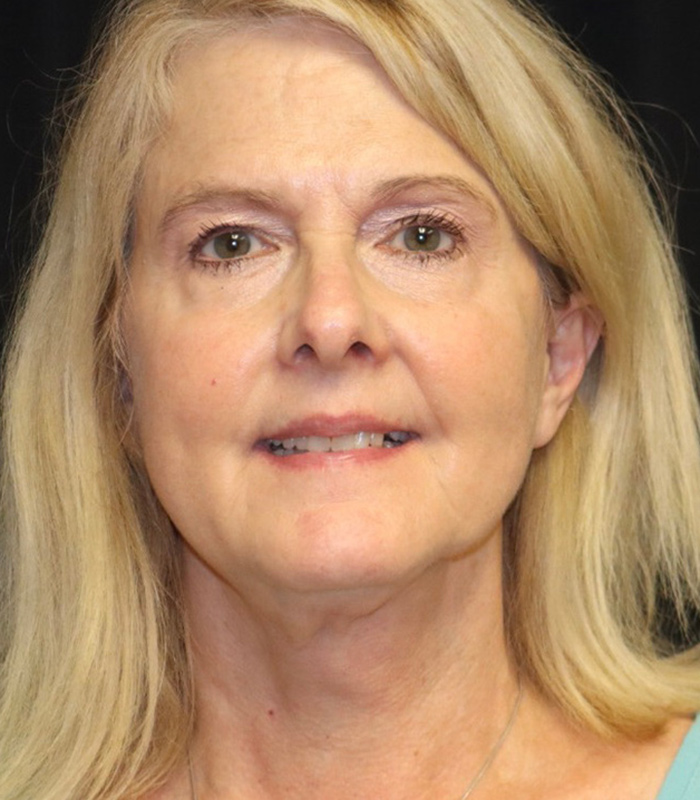 Facelift Before & After Image