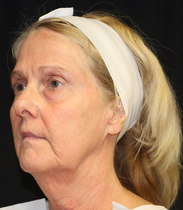 Facelift Before & After Image