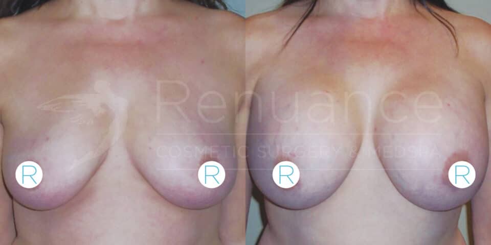 Before and after image showing the results of breast augmentation surgery on a woman's chest. The left side displays the chest before the procedure, and the right side shows the enhanced size and shape of the breasts post-surgery. Two circular labels with the letter "R" are placed on both images for reference.