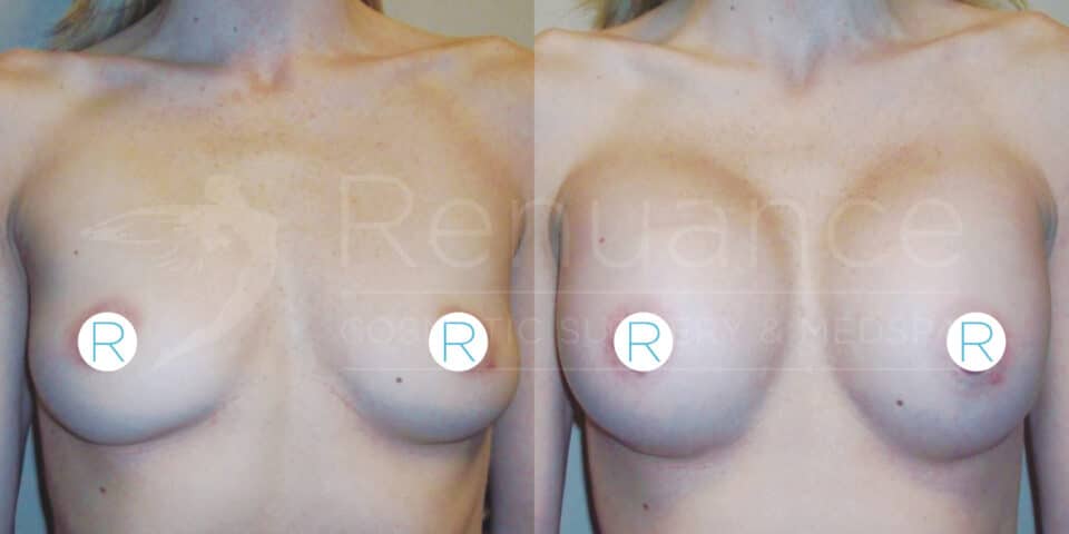 The image is a side-by-side comparison of a woman's chest showing before and after breast augmentation surgery. The left side displays the breasts prior to the surgery, while the right side shows an increased size and fuller shape of the breasts post-surgery. The word "Renuance" can be faintly seen in the background.