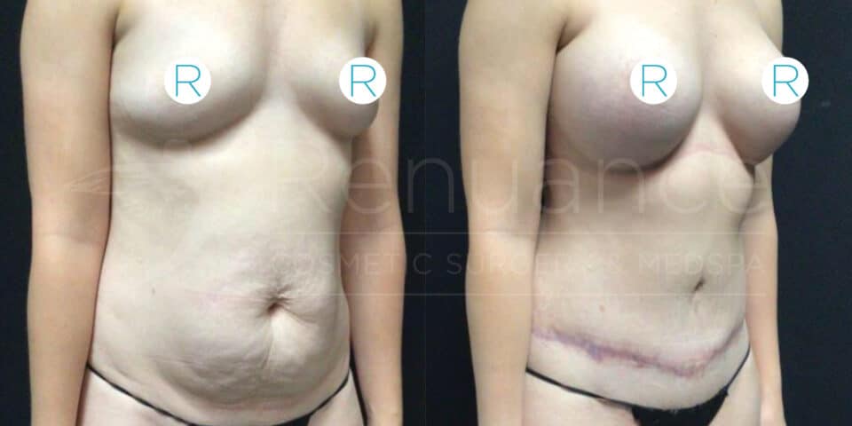 Before and after photos of a person showing the results of a cosmetic surgery. On the left, the person has a sagging abdomen and breasts. On the right, post-surgery, the abdomen appears tighter and the breasts have implants or a lift. Both photos are taken against a black background with a watermark reading "Renuance Cosmetic Surgery Medspa." The letters "R" are marked on the chest area in both images.