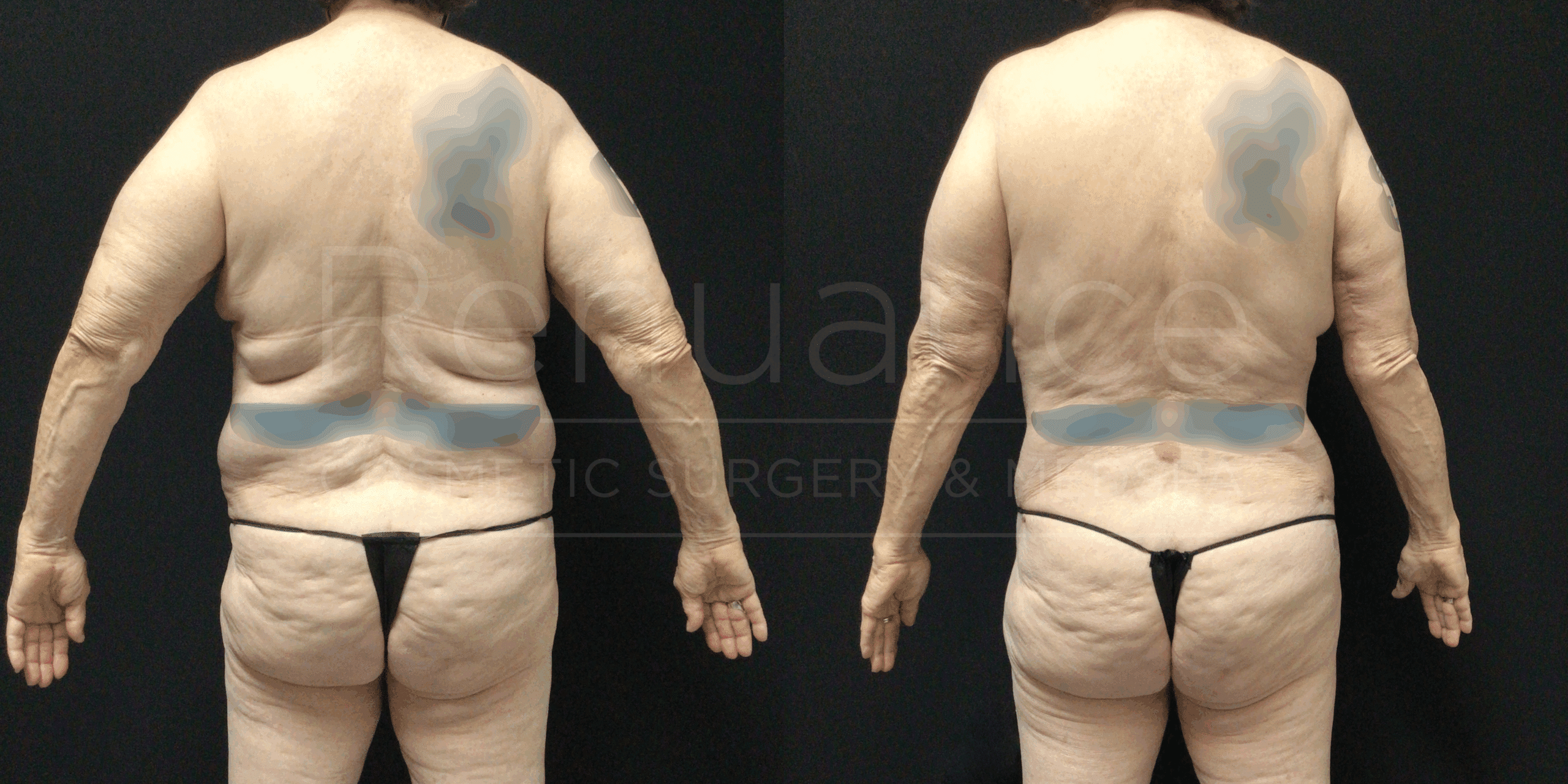 Full body transformation with tummy tuck, liposuction and arm lift before and after