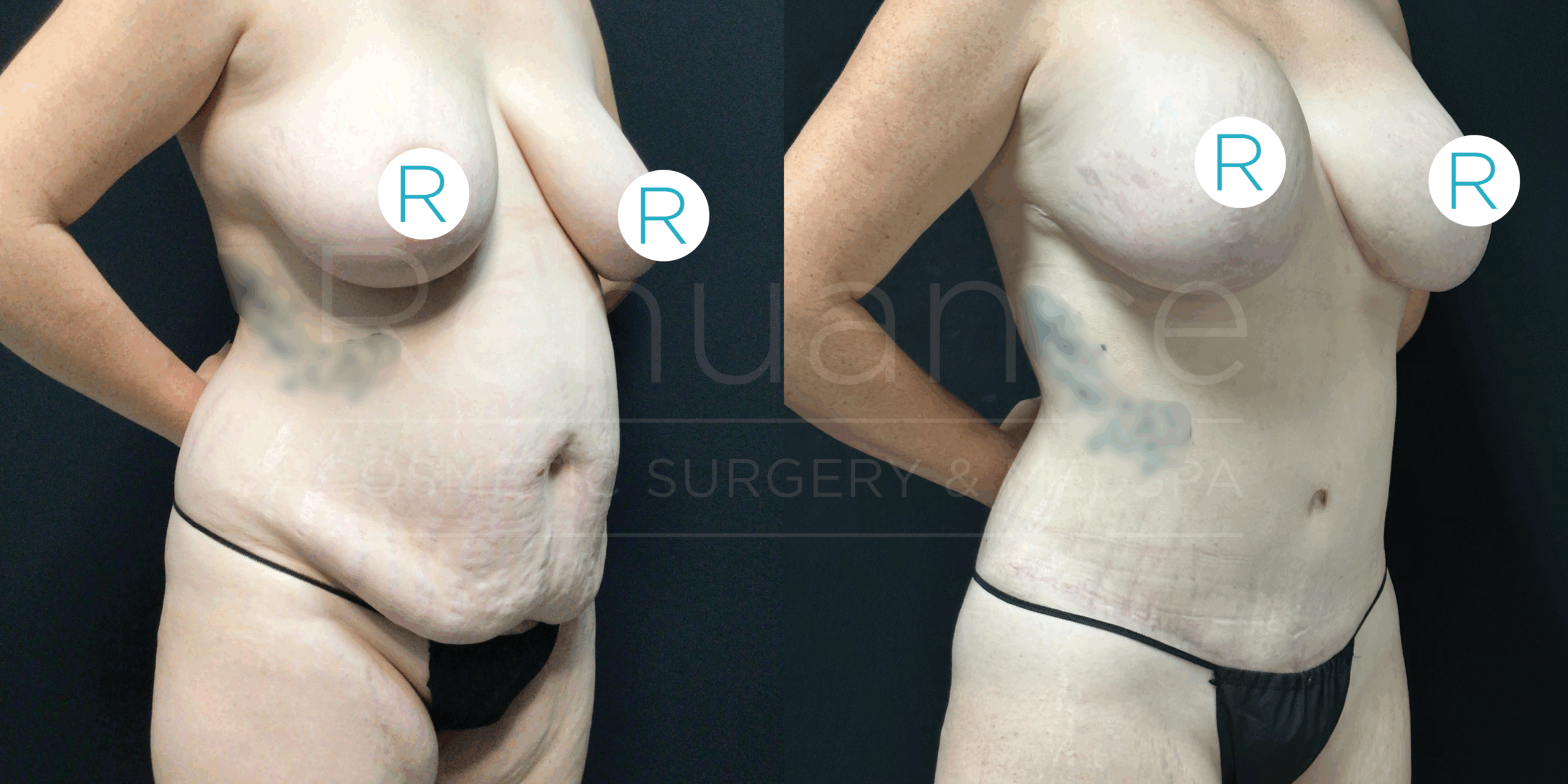 Alt Text: "Side-by-side comparison of a woman's body before and after cosmetic surgery. The left image shows the body before surgery with noticeable excess skin and sagging in the abdominal area. The right image shows the body after surgery with a tighter, more toned appearance in the same area. Both images have a circular opacity on one of the breasts with an 'R' label on it."