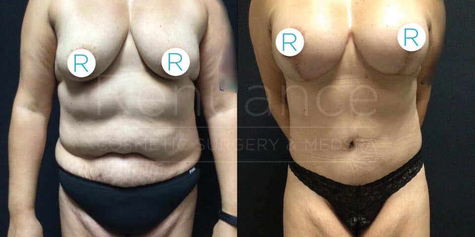 Side-by-side comparison showing the results of cosmetic surgery on a person's torso. The left image depicts the torso before surgery, with visible excess skin and sagging. The right image shows the torso after surgery, with a more toned and smooth appearance. Both images have circular markers labeled "R" on the chest area.