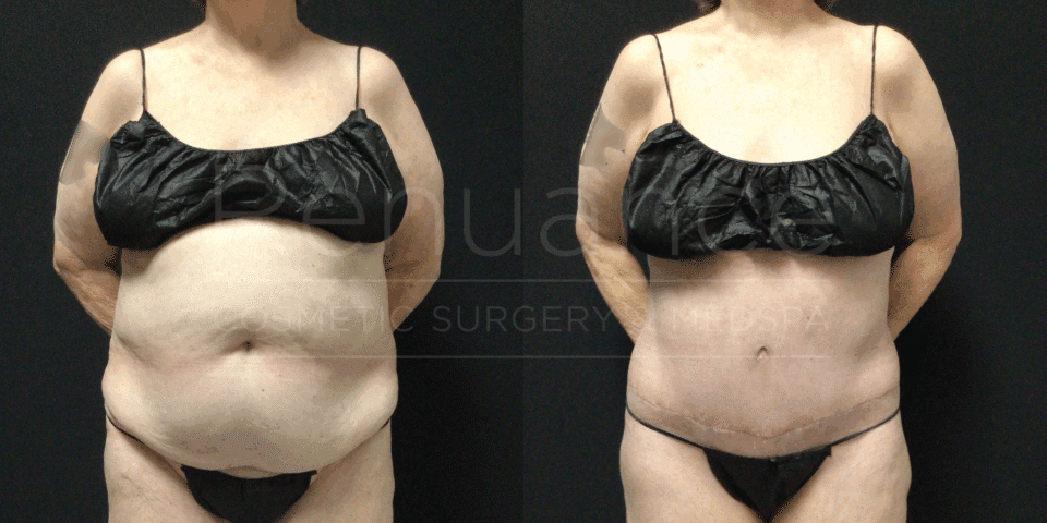 Before and after tummy tuck, liposuction, and arm lift showing full body transformation