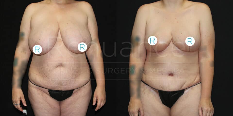 Before and after images of a woman who underwent cosmetic surgery. The images show the front view of her upper body. In the first image, taken before surgery, the woman has larger breasts and a less defined waistline. In the second image, taken after surgery, she has noticeably smaller, more lifted breasts and a more contoured waistline. Both images are set against a black background.