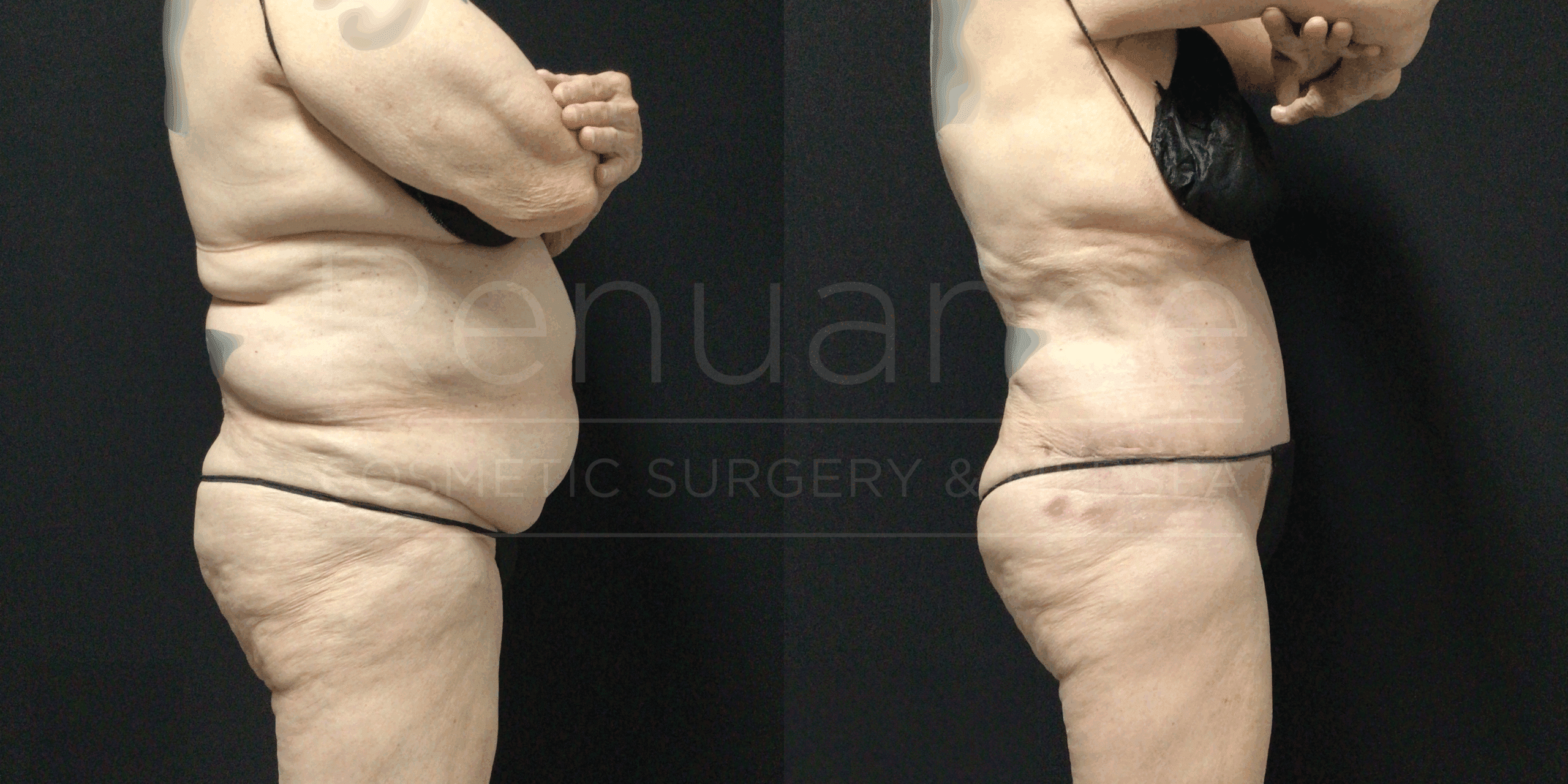 Before and after combined tummy tuck, liposuction and arm lift results