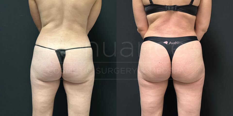 Before and after image showing the results of a cosmetic surgery procedure on a person. On the left, the person has more visible cellulite on the buttocks and upper thighs, and on the right, the skin appears smoother with reduced cellulite. The person is wearing minimal clothing in both images to highlight the changes.