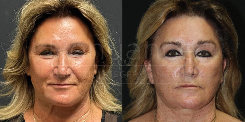 Two side-by-side images of the same middle-aged woman against a black background. The left image shows her before undergoing a cosmetic procedure with visible fine lines, wrinkles, and sagging skin around her eyes and cheeks. The right image shows her after the procedure, with smoother skin, fewer wrinkles, and more lifted features around the eyes and cheeks. Her hair appears the same in both images, styled in loose waves.