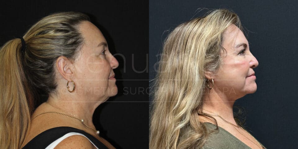 Side-by-side images show a woman's profile before and after a cosmetic procedure. The images highlight significant improvement in the jawline and neck contours. The woman has her hair tied back in both images, and appears to have smoother and more defined facial features in the "after" photo on the right.