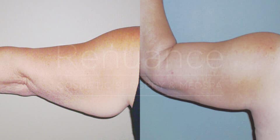 Side-by-side comparison image of an arm before and after cosmetic surgery. The left side shows the arm before surgery with visible sagging skin, while the right side displays the arm after surgery with tighter and smoother appearance. The background contains a faded watermark that reads “Rejuance Cosmetic Surgery & Medspa.”