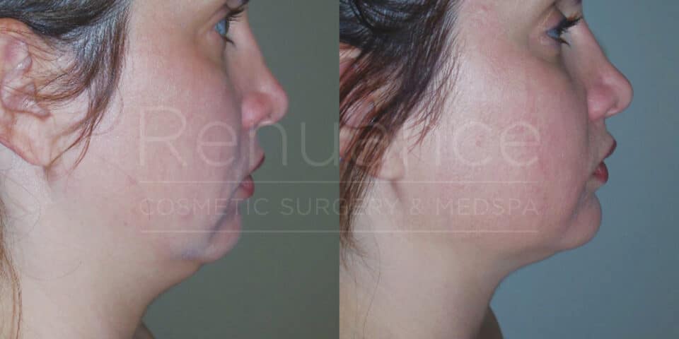 Side-by-side comparison of a woman's lower face and neck before and after cosmetic surgery. The left image shows loose skin and a less defined jawline, while the right image shows tighter skin and a more contoured jawline. The background is neutral, and the woman's hair is tied back in both images. Text overlay reads "Renewance Cosmetic Surgery & MedSpa."