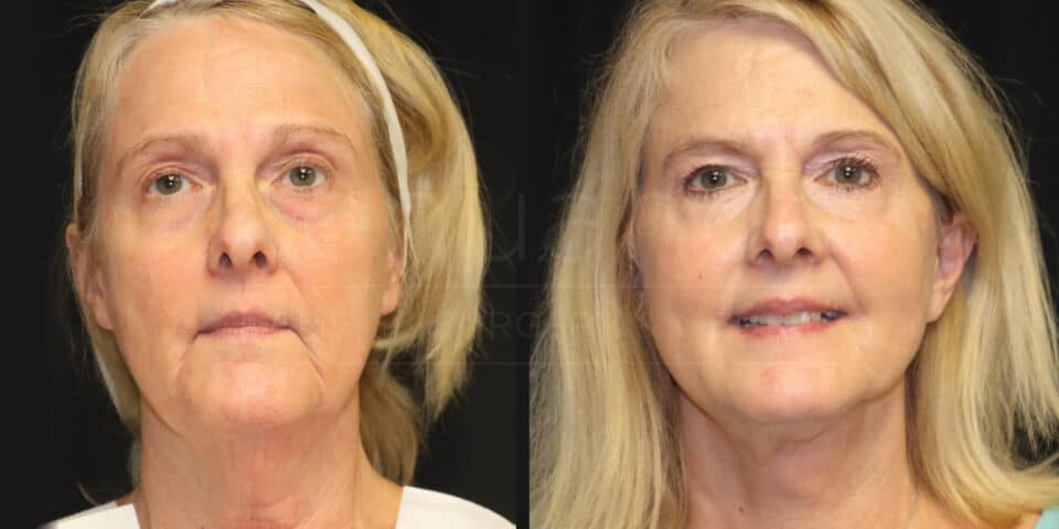 A before and after comparison image of a woman showing the results of a cosmetic procedure. The left side shows the woman's face before the procedure, with a neutral expression and slight sagging around eyes and jawline. The right side shows the woman after the procedure, with a more defined and lifted appearance and a slight smile. Her hair is light blonde, and her skin has a smoother texture in the after photo.