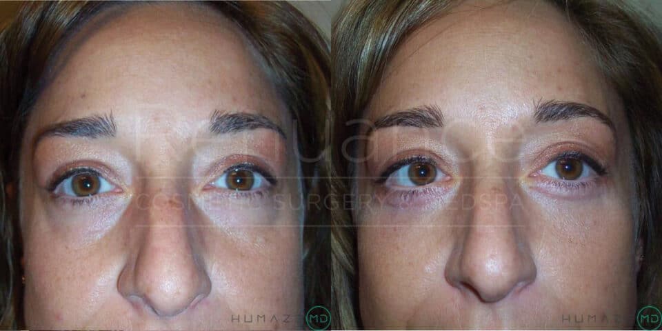 A close-up image shows a woman's face before and after a cosmetic procedure. The left side displays her face before, with visible skin imperfections and a less defined appearance. The right side shows the after results, featuring smoother skin, more symmetrical and contoured features, as well as a refined and rejuvenated look. The overall effect highlights the improvements made by the cosmetic surgery or spa treatment.