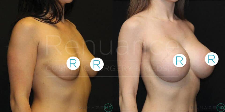 "Side by side comparison of a woman's torso before and after breast augmentation surgery. The left image shows smaller, natural breasts, and the right image shows larger, fuller breasts after enhancement. Both images have circular 'R' logos strategically placed on the breasts."