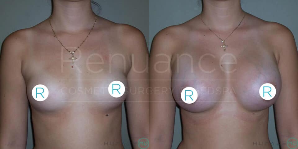 A side-by-side comparison image of a person's upper body showing the results of breast augmentation surgery. The image on the left shows the person before the surgery, and the image on the right shows the person after the surgery with visibly larger and fuller breasts. Both images have white circles with the letter "R" on the chest area, and the background features the text "Renuance COSMETIC SURGERY & MEDSPA" in a semi-transparent overlay.