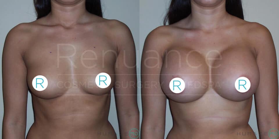 "Before and after comparison of a woman showing the results of breast augmentation surgery, with noticeable changes in breast size and shape. The woman is facing forward in both images, covering her nipples with "R" circles. 'Renuance Cosmetic Surgery Center' watermark is visible across the image."