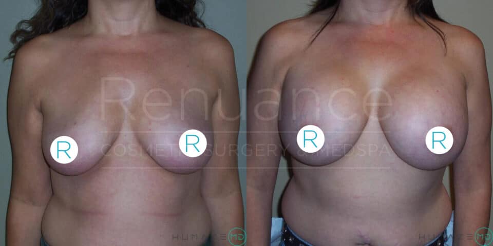 Before and after side-by-side images of a woman's chest showing the results of a cosmetic breast procedure. The left image displays the person's breasts prior to the procedure, and the right image shows the person’s enhanced breast size and shape post-procedure. Circular stickers with the letter "R" cover the nipples for modesty. The logo "Renuance Cosmetic Surgery Center & …" is faintly visible over the images.